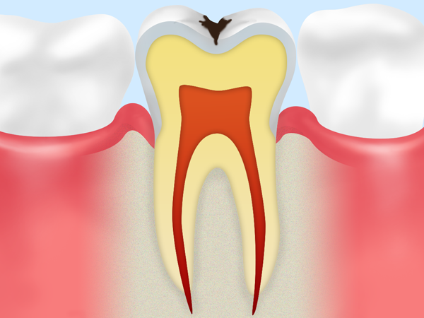 C1　エナメル質の虫歯