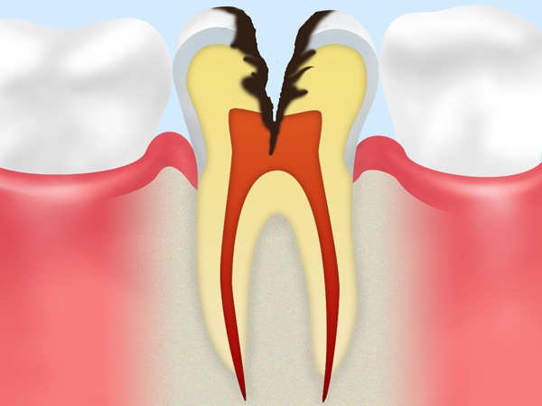 C3　神経に達した虫歯