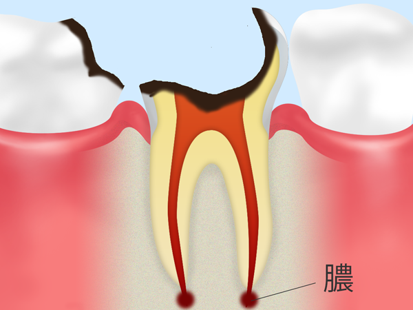 C4　歯根に達した虫歯