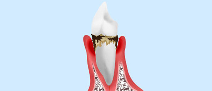 歯周病の原因と治療法