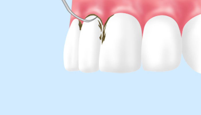 プラーク・歯石を徹底的に除去(歯周基本治療)