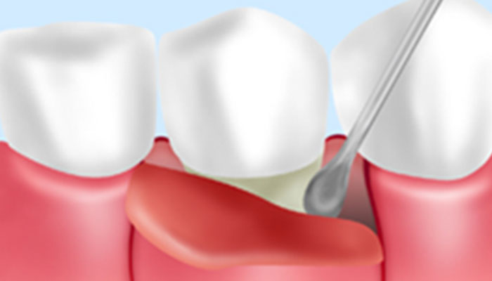 歯周外科治療（FOP）