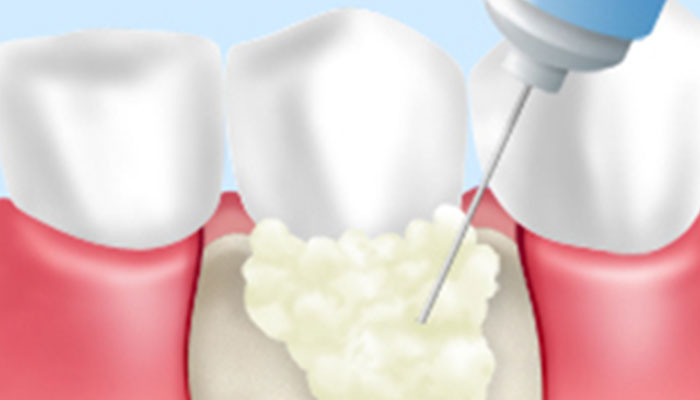 歯周組織再生療法
