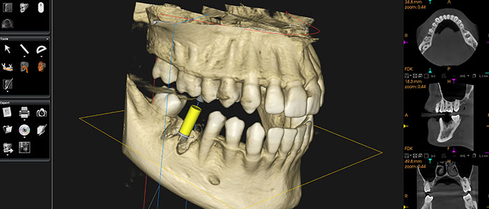 歯科用CTを活用した抜歯